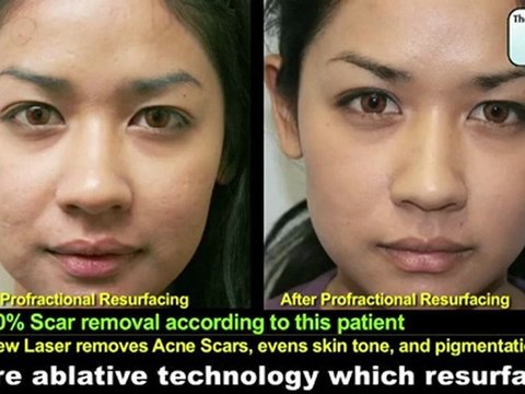 Profractional Laser Acne Scar Removal Resurfacing Skin