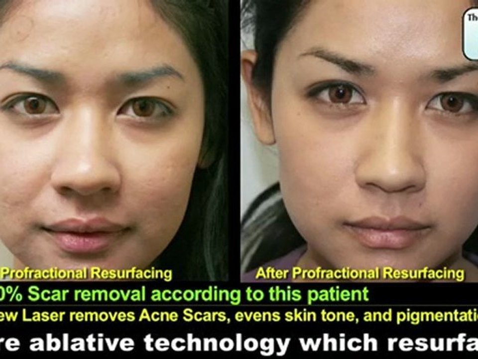 Profractional Laser Acne Scar Removal Resurfacing Skin