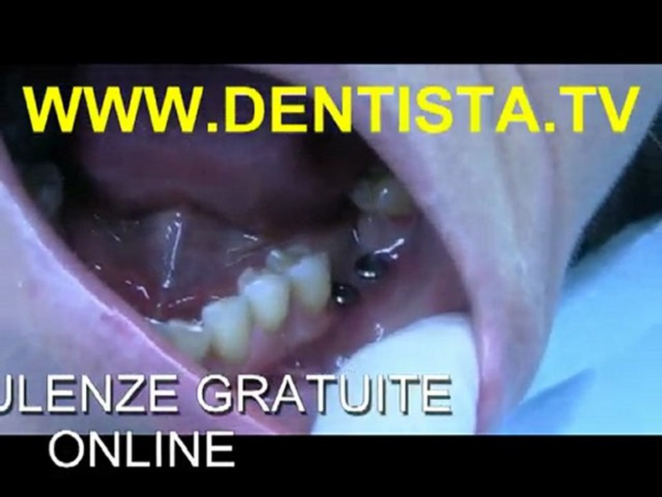 IMPLANTOLOGIA DENTARIA IMPIANTI DENTARI