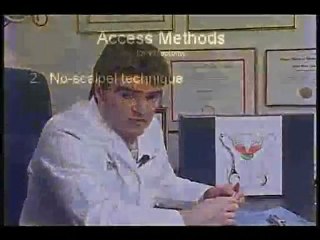 Vasectomy Video - How Vasectomy is Done