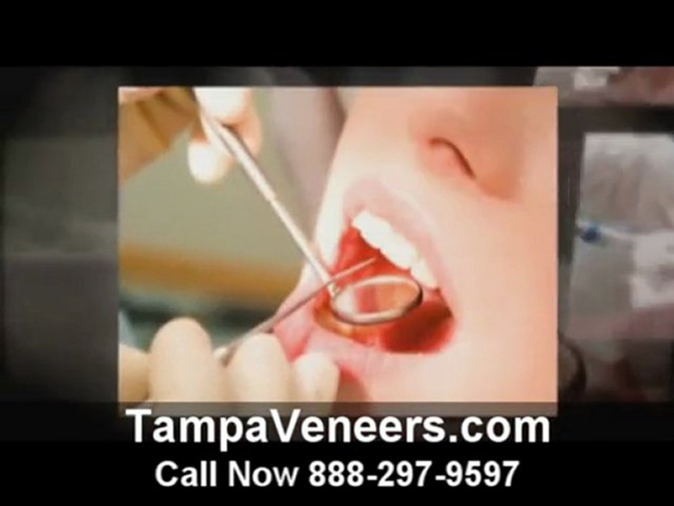 Tampa Veneers