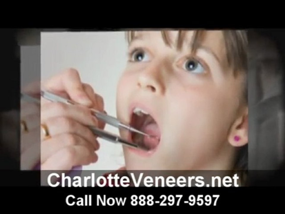 Veneers in Charlotte