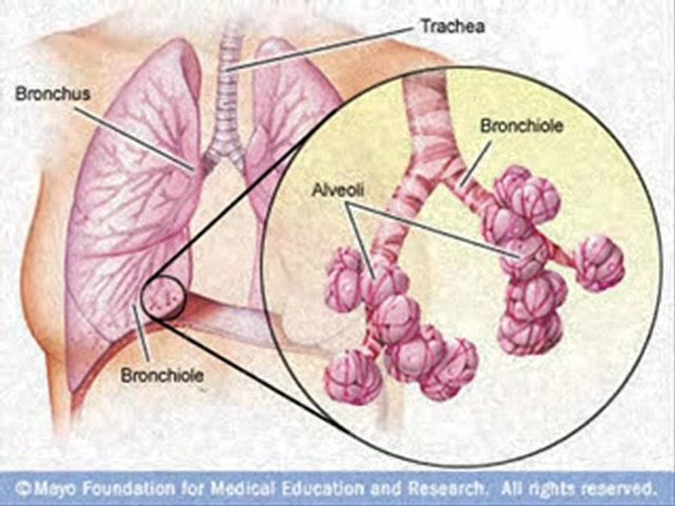 Asbestosis Picture
