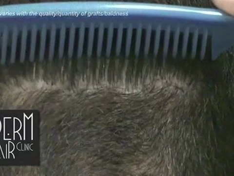 FUE hair transplantation – Follicular unit Extraction_s