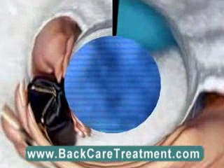 Long term back pain relief