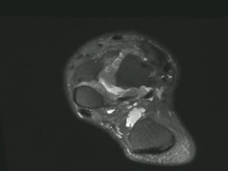 High resolution MR 3D image of the foot