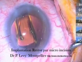 Restor implantation