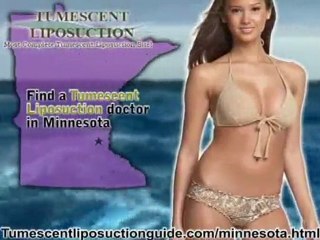 Tumescent Liposuction Minnesota