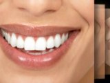 Laser Zoom Teeth Whitening By Best Winnipeg Dentist