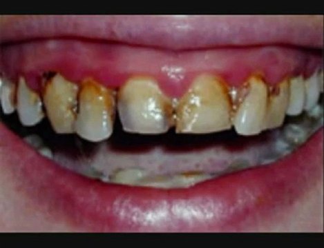 Gold coast cosmetic dentist Bright Smiles At Cosmetic Dental