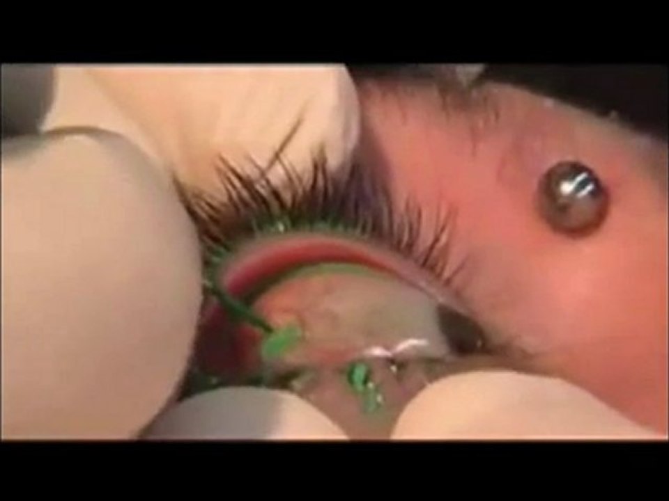 Tattoeage in je oog