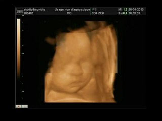 Echographie 4D de Brandon à 30 SA