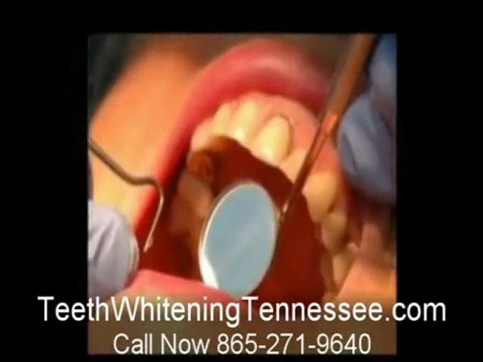 Teeth Whitening Tennessee