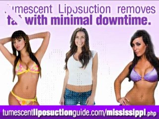 Tumescent Liposuction Mississippi