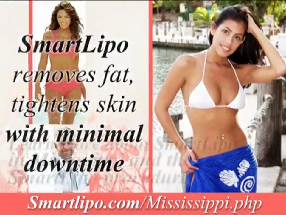 Smartlipo Mississippi