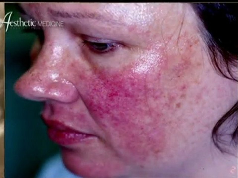 Treatment of Rosacea