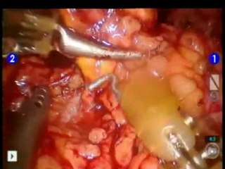 Robotic Surgery