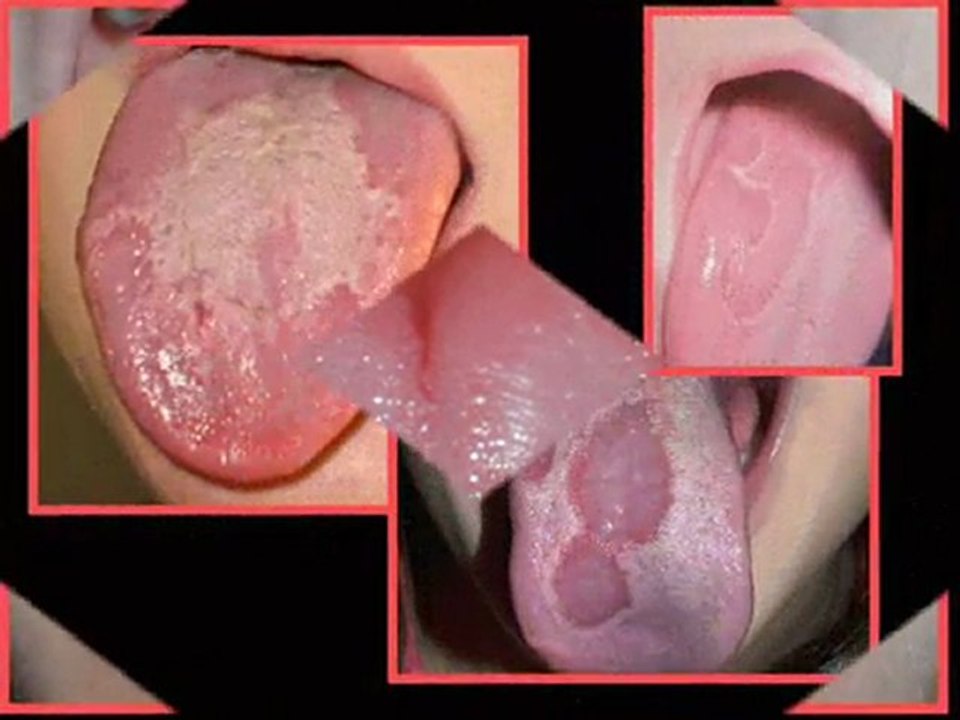 Natural Geographic Tongue Treatment - Geographical Tongue Pi