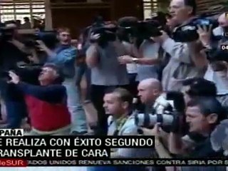 Se realiza con éxito segundo transplante de cara