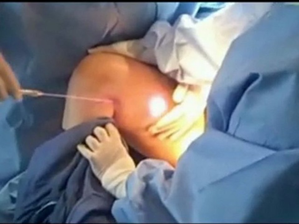 LIPOLIFT™ III Informational Video - LASER LIPOLYSIS