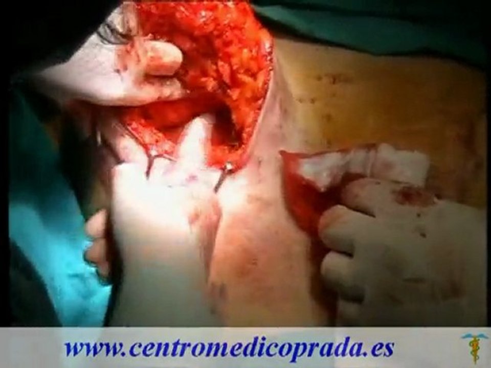 Clinica Prada - Mamoplastia de reducción- Reducción de mamas