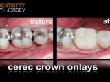 Crowns with CEREC® in Bergen County, New Jersey