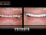 Porcelain Veneers in New Jersey at Laser Dentistry of North