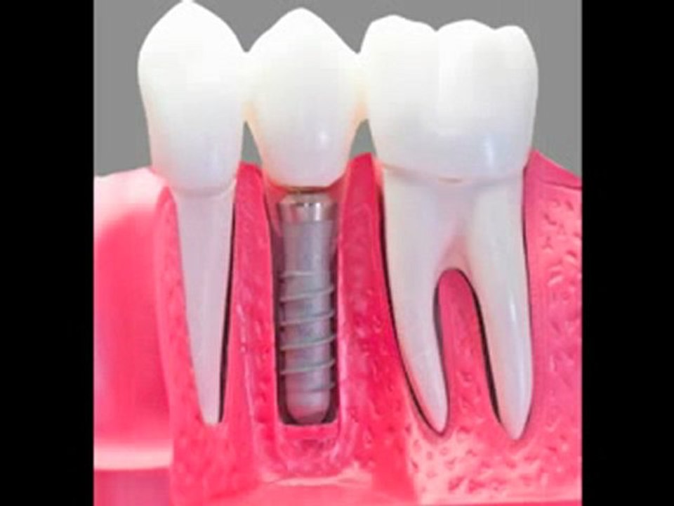 "La Jolla Dental Implants, Dentists, Dentist San Diego"