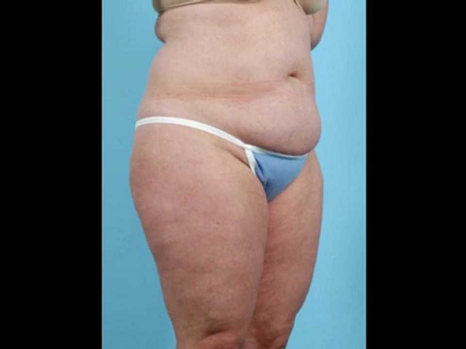 Neck Liposuction Surgery Roseville CA.