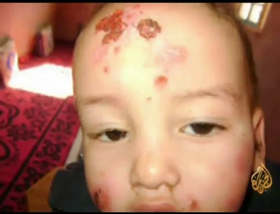 الليشمانيا ينتشر في الراشيدية