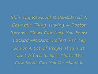 Get Rid Of Skin Tags Safe And Natural At Home