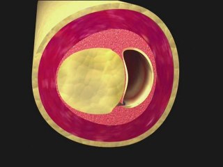 To fight heart attack and atherosclerosis