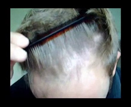 Saç Ekimi Videoları Her Zaman Gerçeği Yansıtırmı?