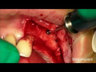 bone grafting - Part 2