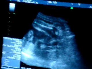 échographie 7ème mois