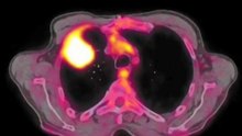 L'examen PET-CT