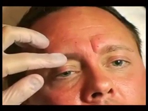 Botox Treatment Folsom Botox Folsom CA