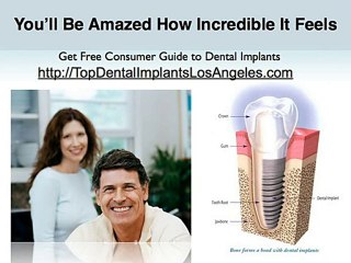 Dental Implants Los Angeles | Consumer Guide to Dental Impl