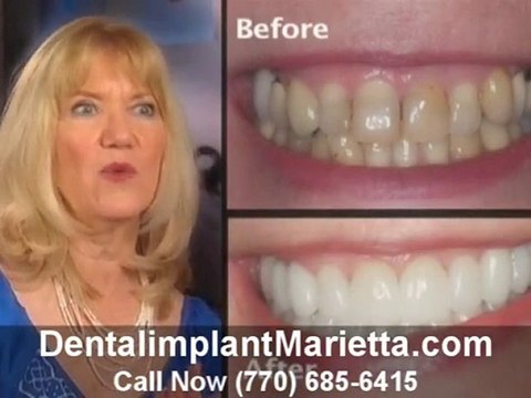 Dental Implants Marietta