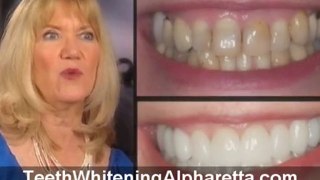 Teeth Whitener Alpharetta