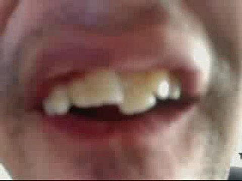 Braces monmouth county NJ,Braces freehold ...