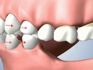 Houston Implant Dentist - Multiple Teeth Missing Problems