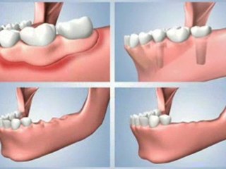Houston Dental Implant - Multiple Missing Teeth Solution