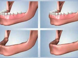 How To Get Teeth In An Hour - Houston Dental Implants