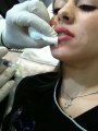 Lip and smile line dermal fillers cosmetic surgery ...