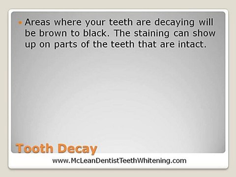 McLean VA Dentist Teeth Whitening – What causes tooth sta