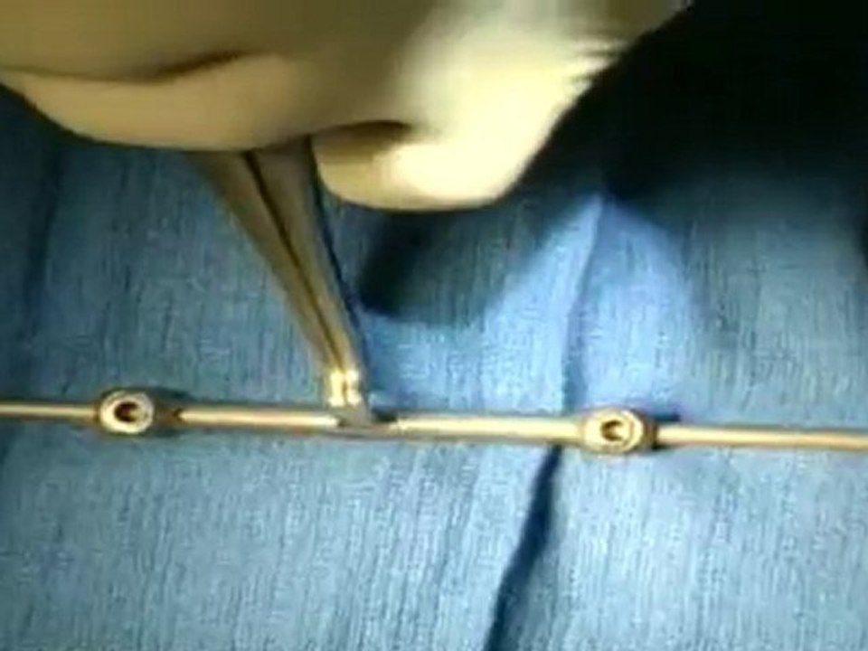 VEPTR Procedure