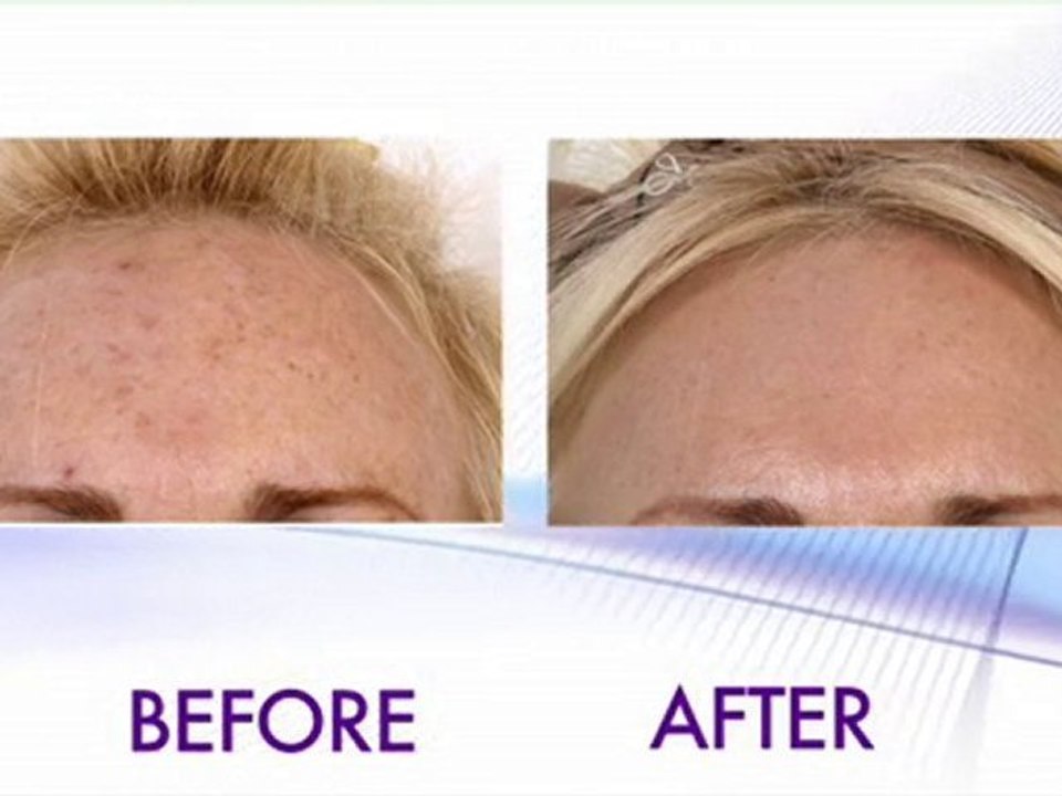 Fraxel Laser Skin Resurfacing – Vein & Cosmetic Center Tampa