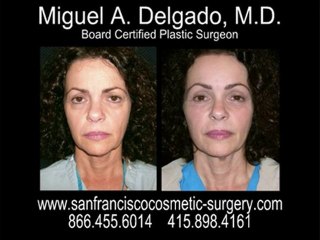 San Francisco Brow- Lift Photos