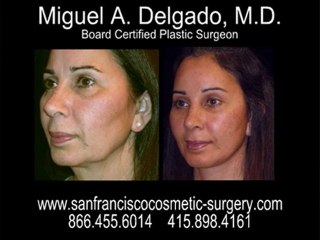 San Francisco Facelift Photos